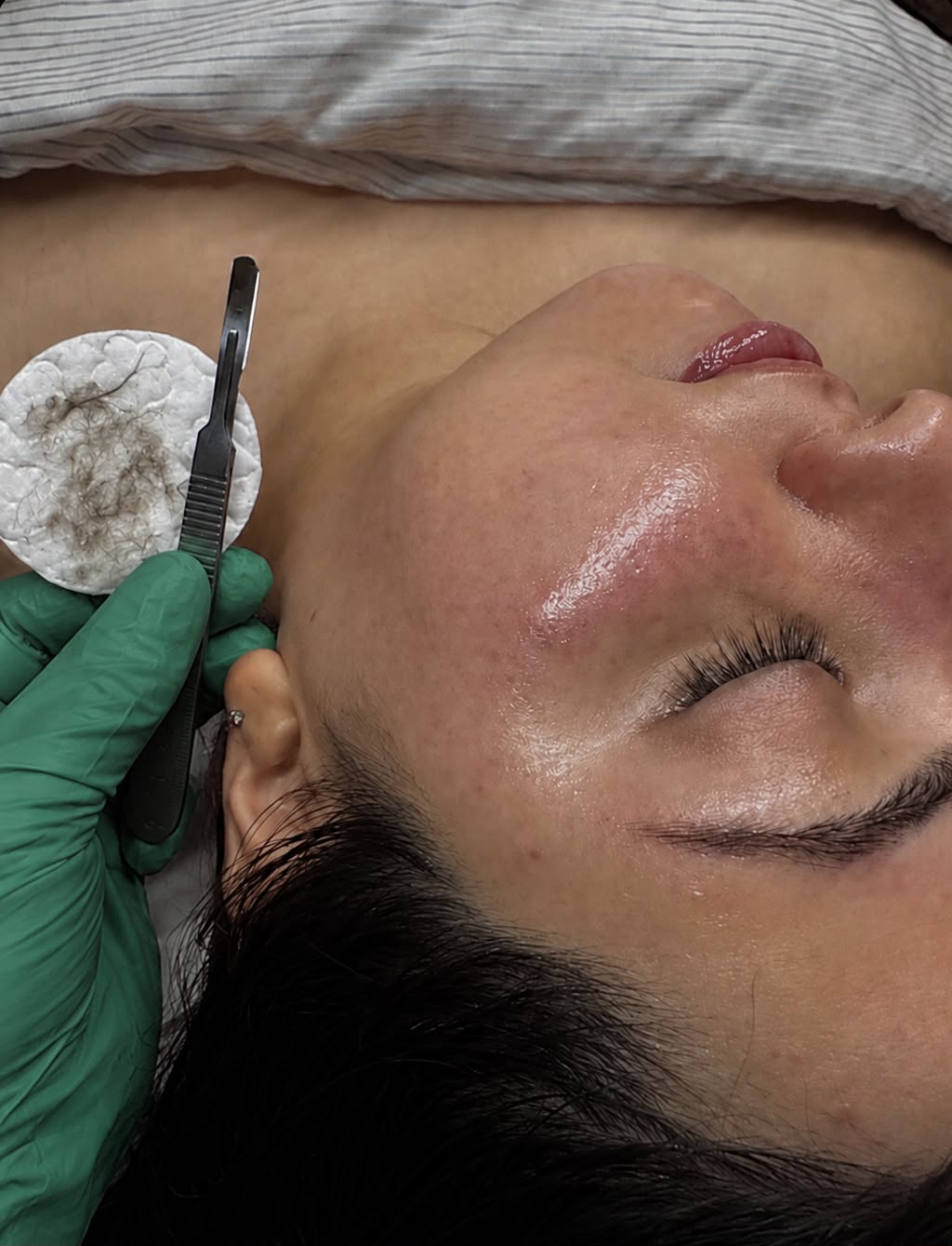Dermaplaning